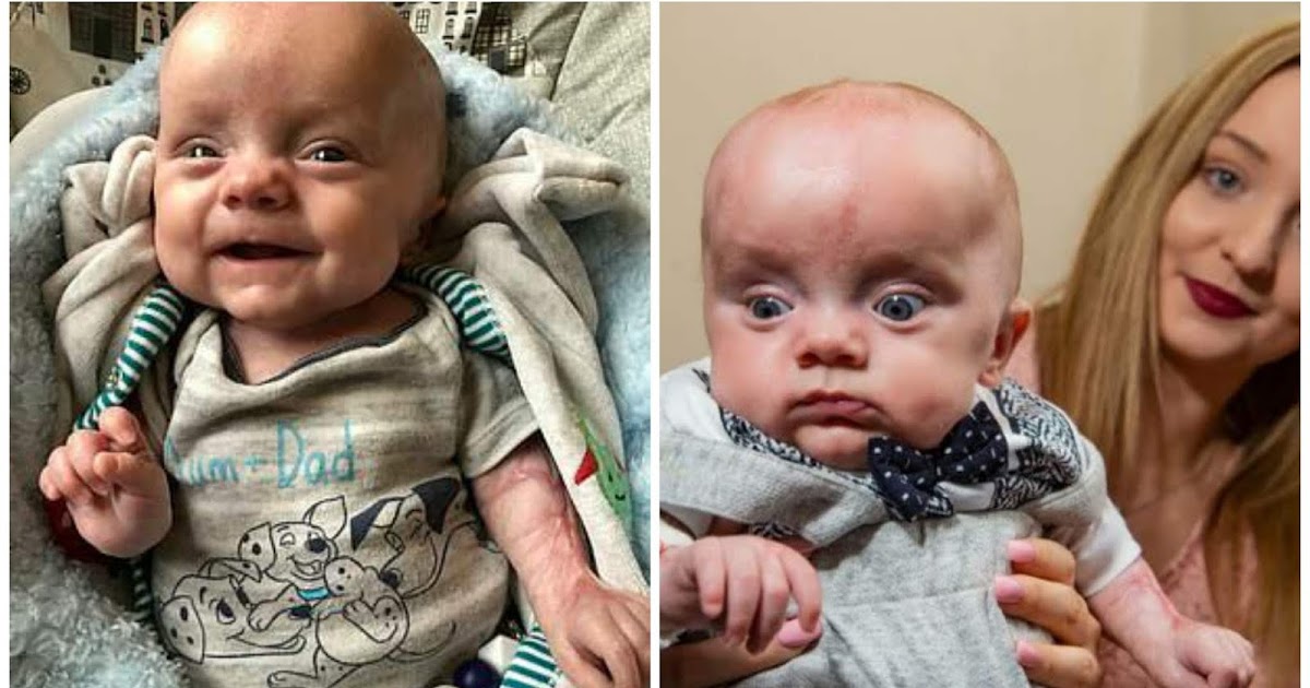 Miracle Baby Born With No Skin, Died Twice, Still Surviving!