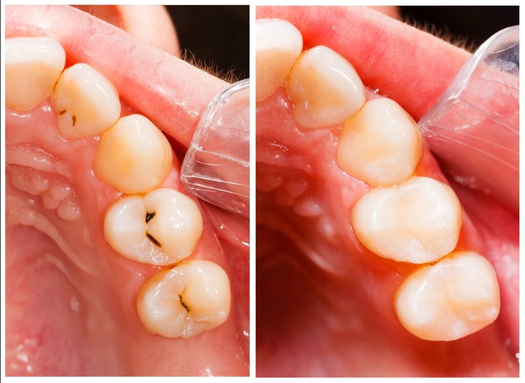 New Treatment Makes Teeth Grow Back