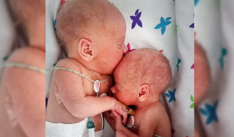Parents Take Photos of Premature Baby’s First Hug to Twin Brother Since Being Separated at Birth