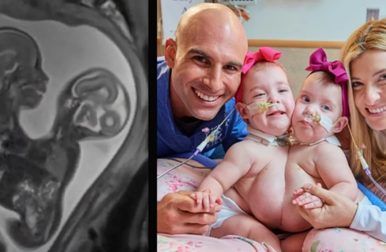 Frightened Parents ‘Give It To God’ As Conjoined Twins Are Separated In 10-Hour Surgery