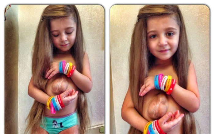 Girl Born With Heart Outside Chest Is A True Fighter And Inspiration