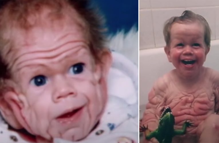 Tomm Tennent: The Unique Baby Born With Enough Skin To Cover The Body Of A Five-year-old Child