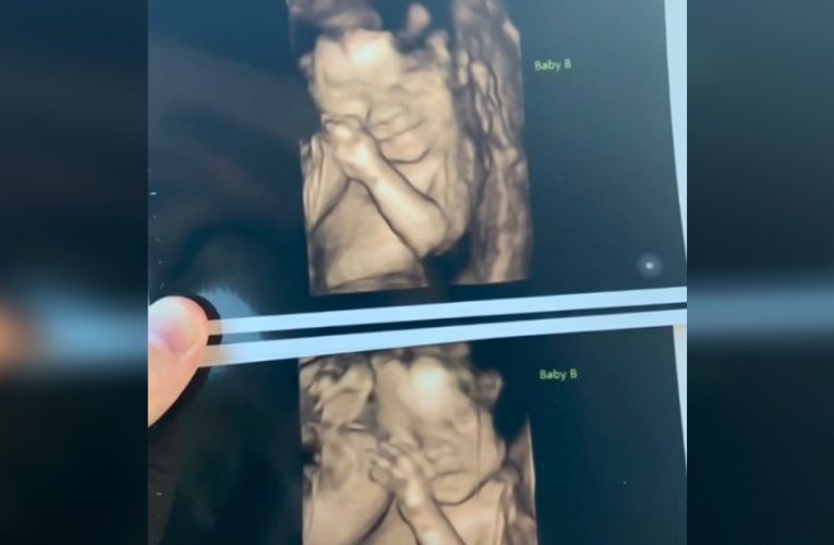 Mom Gives Birth To Exceptionally Rare Twins That Rapidly Make Headlines