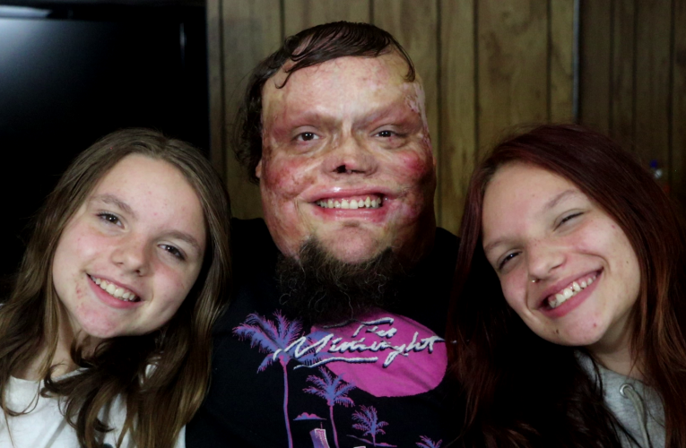 98% Burns As A Toddler, But Now He’s Raised Two Kids As A Single Dad – “God Does Miracles”