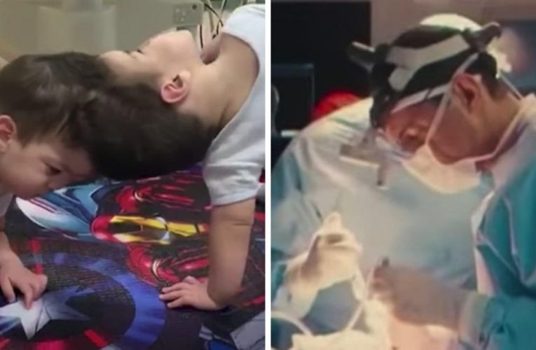 Conjoined Twins, 3, Are Separated In Historic Surgery That Utilized Virtual Reality